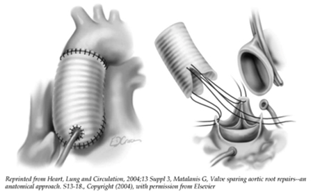 David Procedure